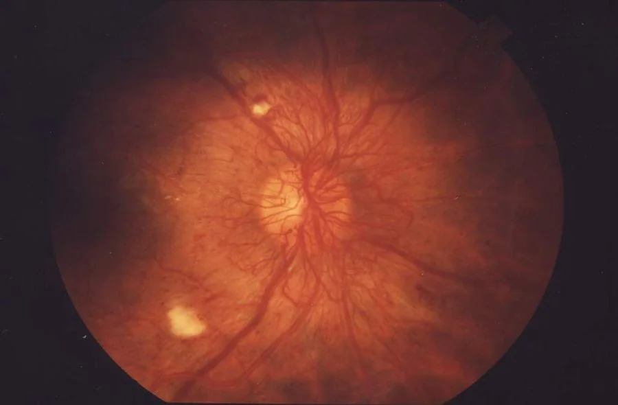 Colour fundus photograph showing proliferative diabetic retinopathy, with abnormal new blood vessels and fibrous tissue on the retinal surface, retinal haemorrhages and exudates.
