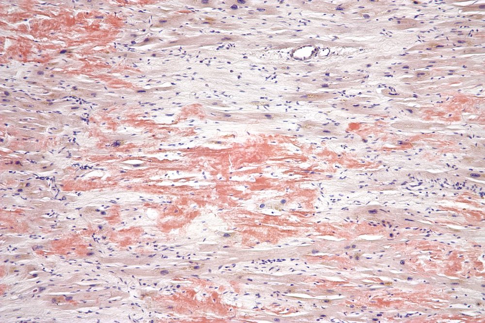 Micrograph of cardiac muscle stained with Congo red, showing amyloid deposited between the myocytes as washed-out extracellular material, alongside yellow-brown granular lipofuscin pigment.