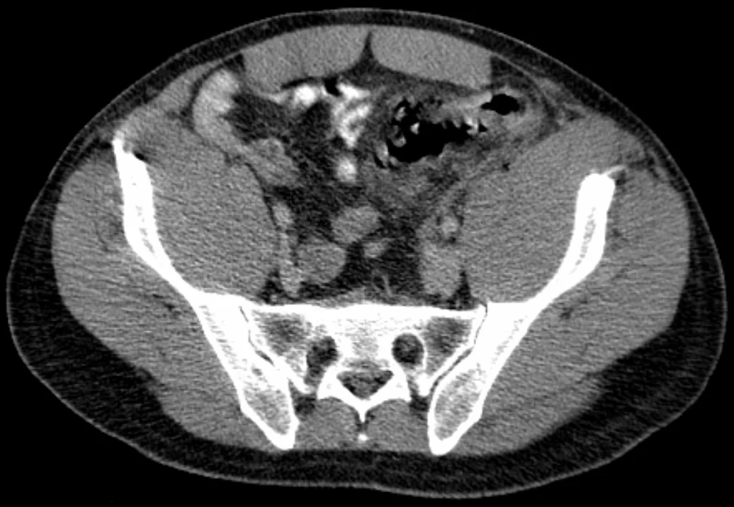 Axial CT image of the abdomen showing sigmoid diverticulitis with colonic wall thickening, surrounding fat stranding and extraluminal gas indicating perforation.