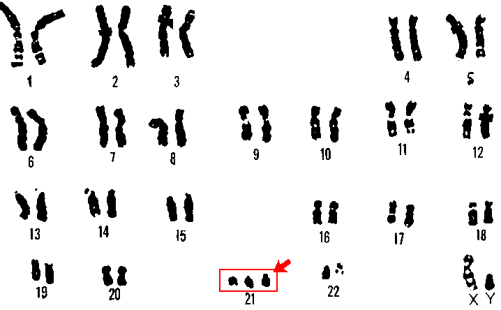 A karyotype image showing 47 chromosomes arranged in pairs, with three copies of chromosome 21 instead of the usual two.