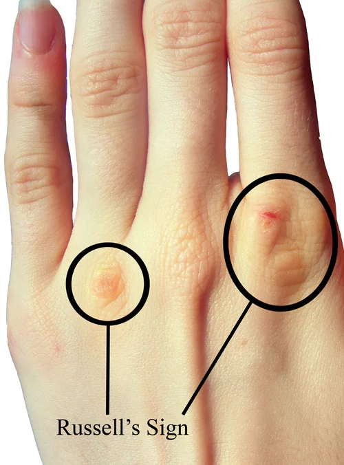 Close-up photograph of the back of a hand showing thickened, callused skin over the knuckles of the index and ring fingers.