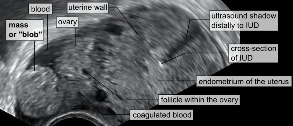 Transvaginal ultrasound image showing an inhomogeneous adnexal mass adjacent to the ovary, the blob sign of an ectopic pregnancy.
