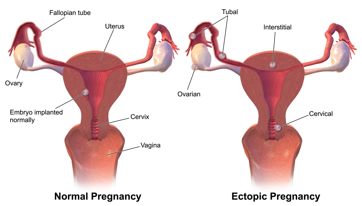 Diagram contrasting a normally implanted intrauterine pregnancy with the tubal, interstitial, ovarian and cervical sites of ectopic implantation.