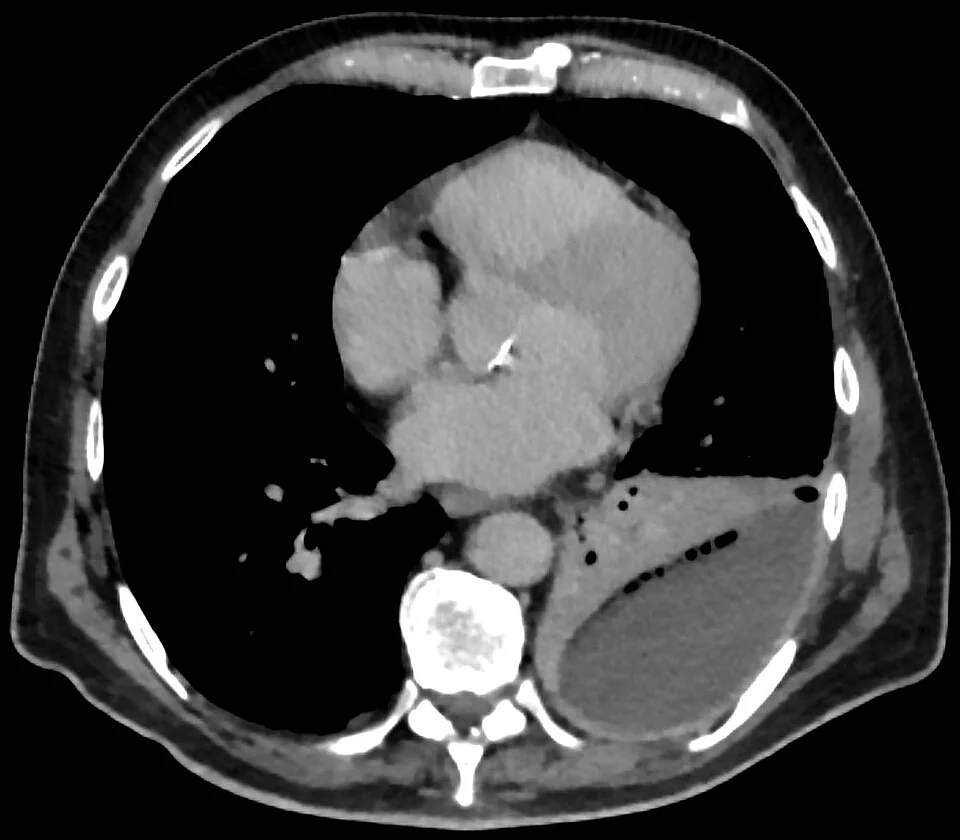 Axial contrast-enhanced CT of the chest showing a large collection in the left posterior pleural space containing several small dark gas locules, with the adjacent lung consolidated and the thickened pleural layers enhancing around the collection.