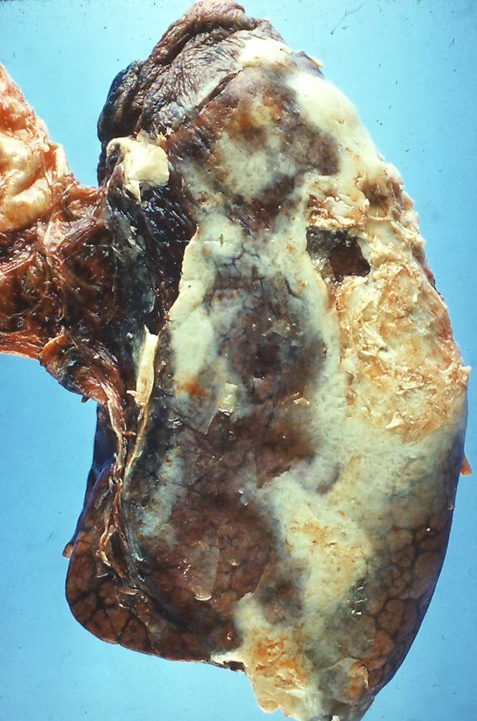 Post-mortem lung specimen with the pleural surface covered by a thick, adherent, creamy yellow-white purulent exudate obscuring the underlying lung tissue.