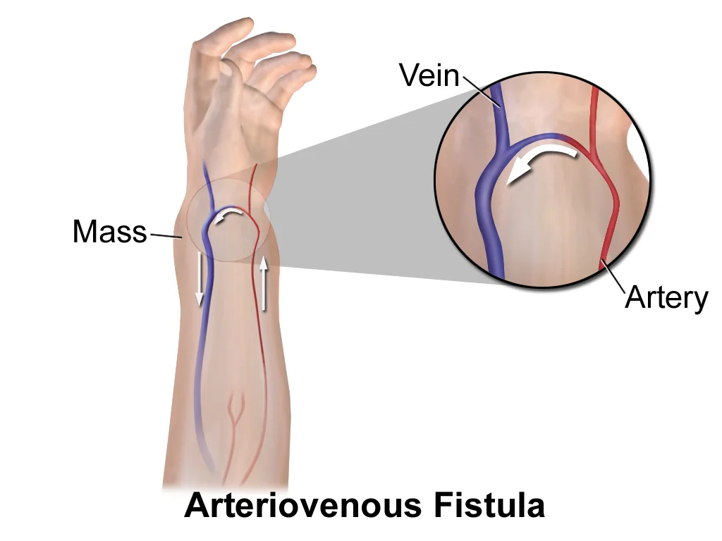Illustration of an arteriovenous fistula in the forearm, showing a surgical connection between an artery and an adjacent vein, with two dialysis needles inserted into the dilated arterialised vein.