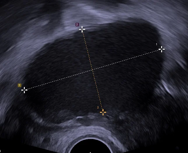 Transvaginal ultrasound showing an endometrioma of the right ovary with grainy, low-level internal echoes.