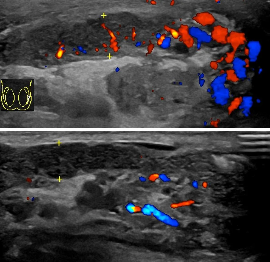 Scrotal ultrasound image with colour Doppler showing an enlarged epididymis with markedly increased colour flow signal indicating hyperaemia, adjacent to the testis.