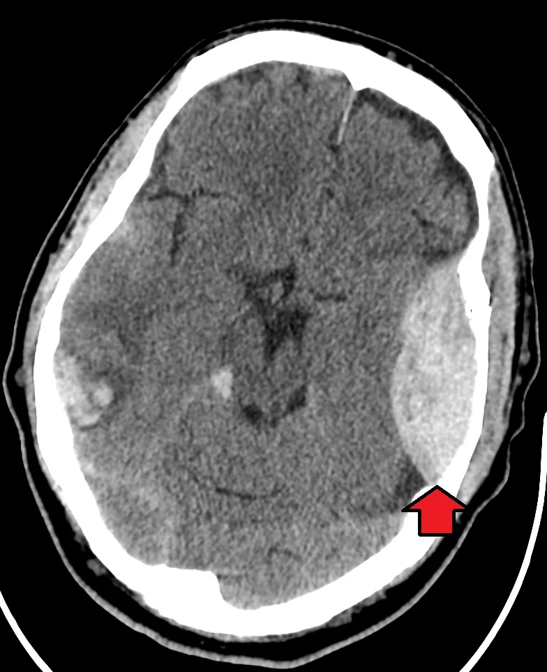 Axial CT brain scan showing a biconvex, lens-shaped area of hyperdensity adjacent to the skull, consistent with extradural haemorrhage, causing compression of the underlying brain.