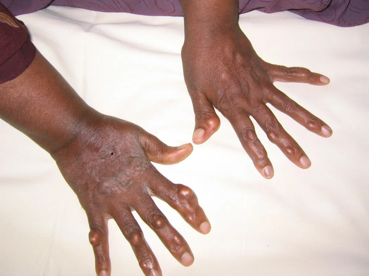 Photograph of both hands of a young patient, showing multiple firm rounded nodules over the extensor tendons of the fingers and the backs of the hands.