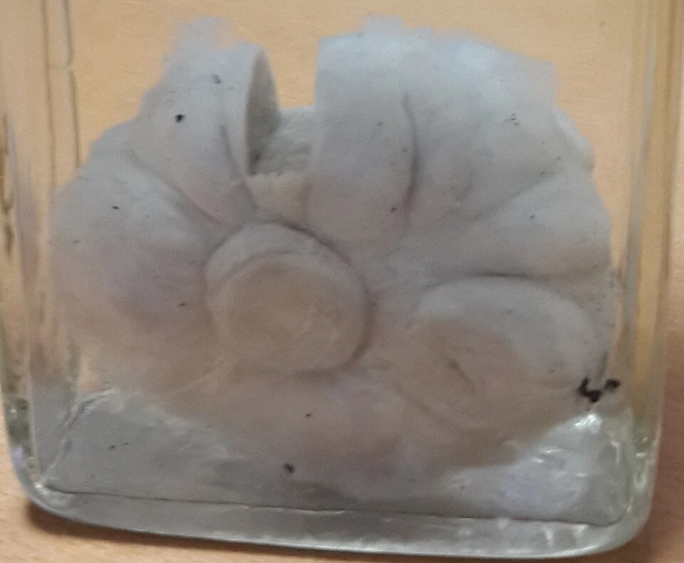 An excised fibroadenoma preserved in a specimen jar, showing a well-circumscribed pale grey-white lobulated mass with a whorled cut surface and no infiltration of surrounding tissue.