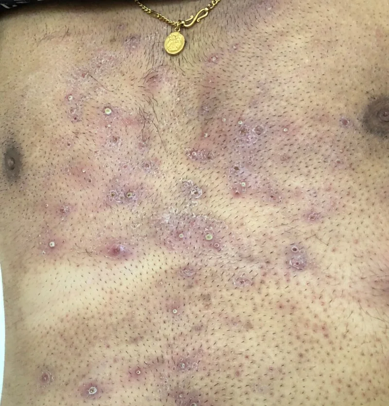 Photograph of the chest showing numerous follicular pustules and erythematous papules following shaving, each centred on a hair follicle.