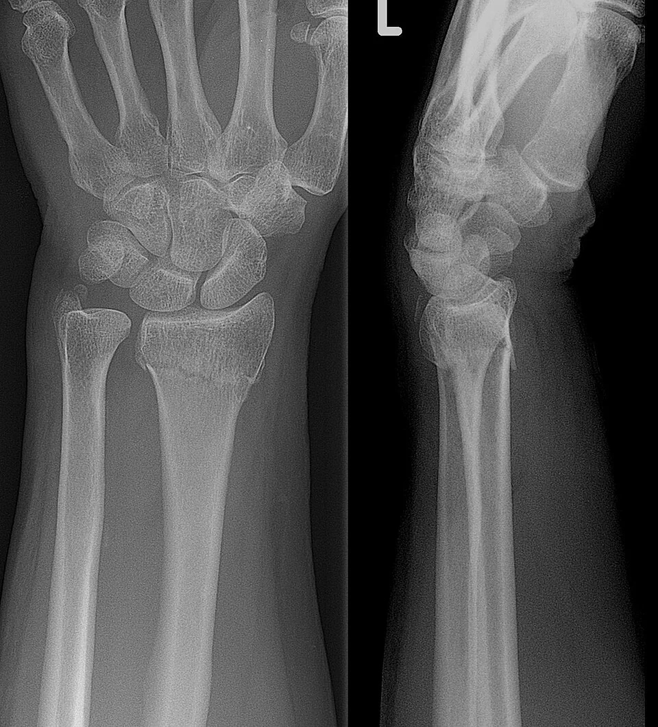 Two radiographs of a left wrist side by side. The posteroanterior view shows a transverse lucency across the distal radial metaphysis with loss of radial height; the lateral view shows the distal fragment tilted and displaced towards the back of the wrist.