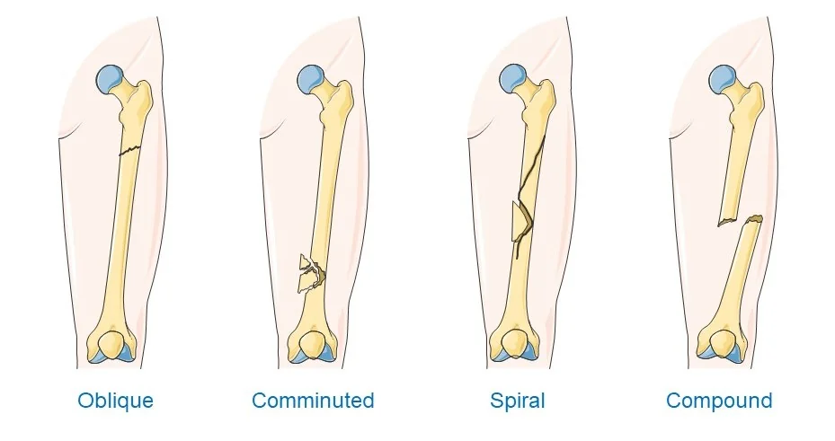 Illustration comparing fracture patterns in a long bone, showing transverse, oblique, spiral, comminuted and greenstick fracture lines alongside an intact bone for reference.