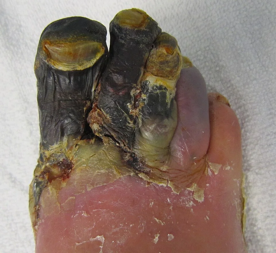 Photograph of a right foot in which the first to fourth toes are blackened, shrunken and mummified, with a sharply defined margin between the dead tissue and the surrounding viable skin.