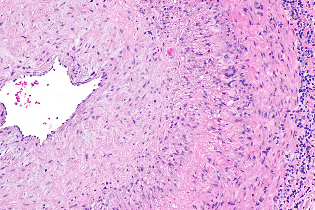 Photomicrograph of a temporal artery biopsy in giant cell arteritis, showing granulomatous inflammation of the vessel wall with disruption of the internal elastic lamina.