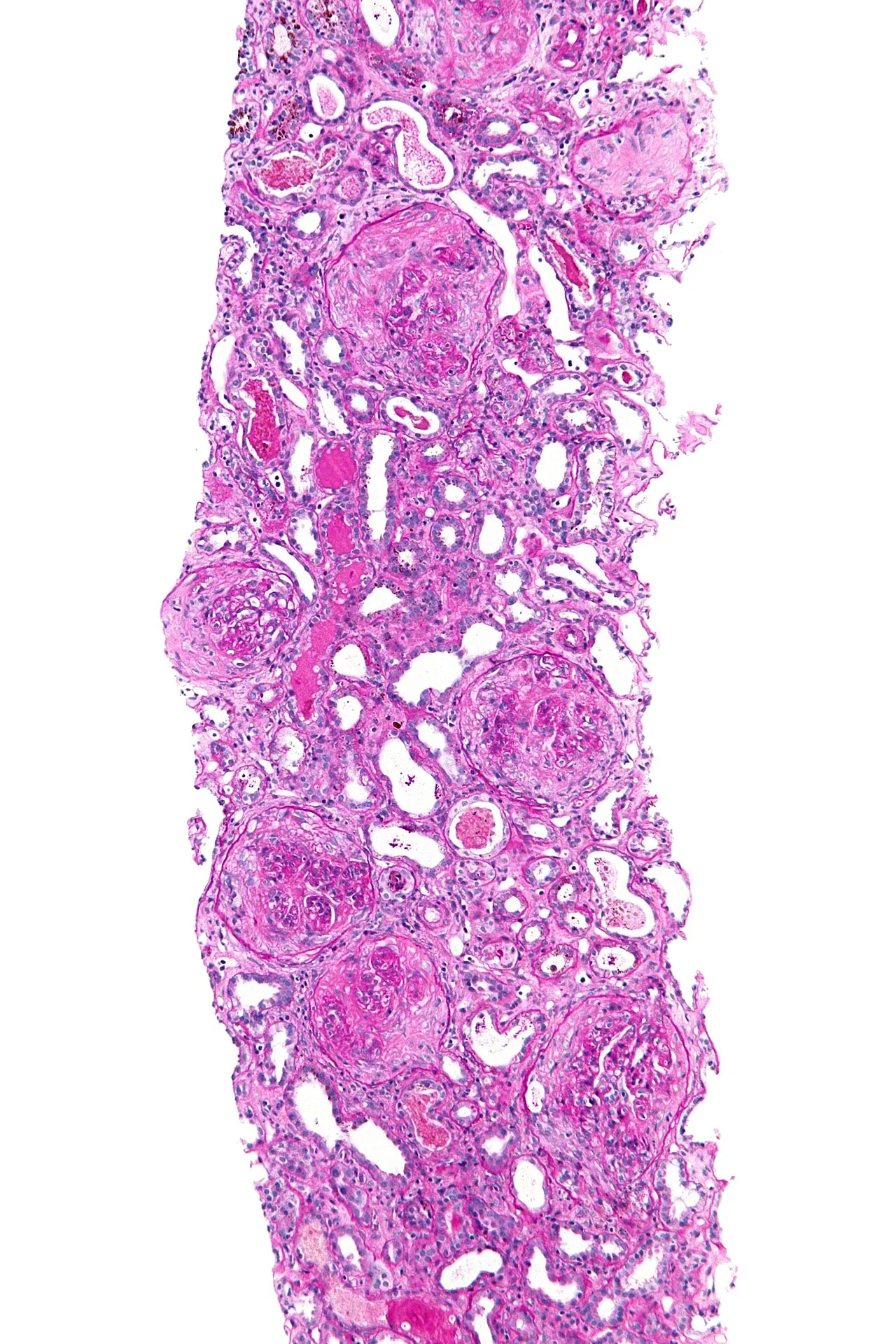 Light micrograph of a renal biopsy showing a glomerulus with a dense cellular crescent of proliferating cells filling Bowman's space and compressing the glomerular capillary tuft.