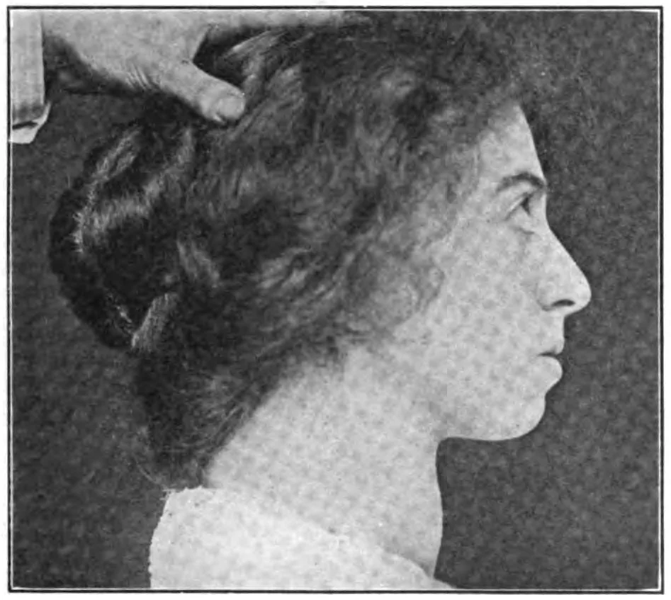 Historical black and white profile photograph of a woman's head and neck with her hair held back, showing marked forward protrusion of the eyeball with sclera visible above the iris and fullness of the anterior neck.