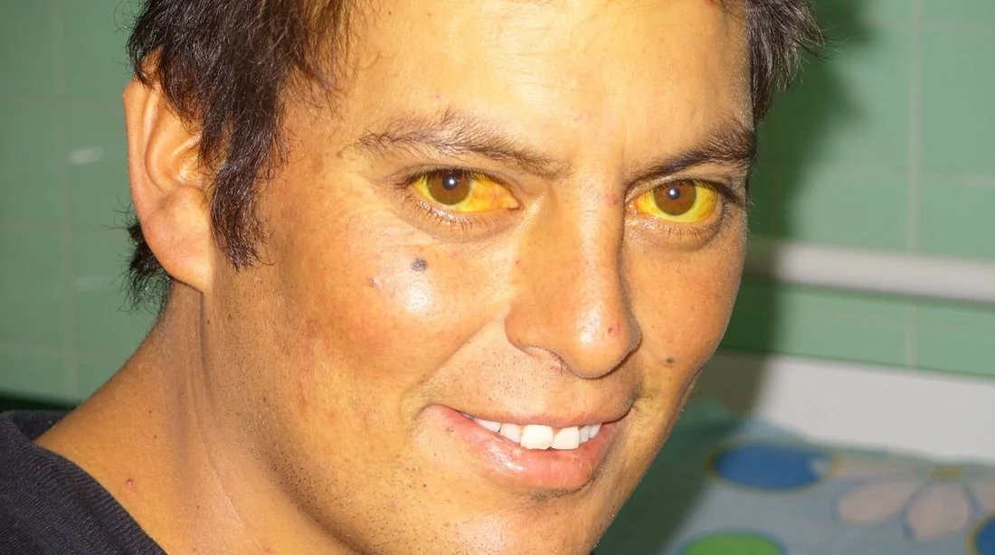 Photograph showing yellow discolouration of the sclera (scleral icterus) in a jaundiced patient.
