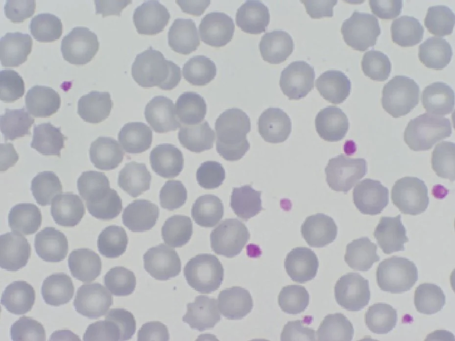 Peripheral blood film showing spherocytes - small, dense, round red blood cells lacking the normal central pallor.