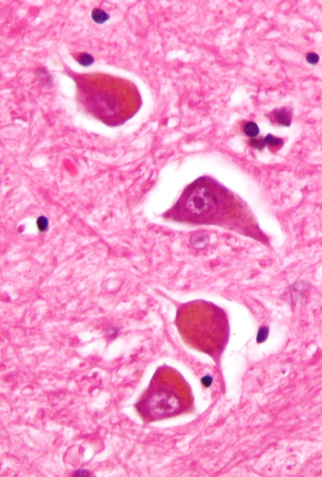 Brain histology showing Alzheimer type II astrocytes, with enlarged, pale, swollen nuclei and scant visible cytoplasm.