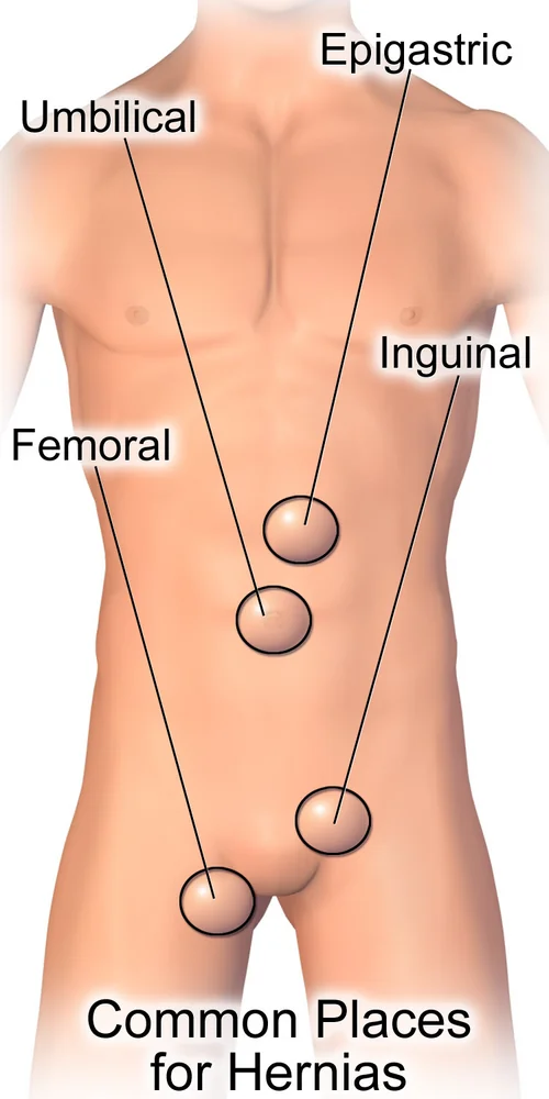 Illustration of the front of a male torso with four circled sites labelled epigastric in the upper midline, umbilical at the navel, inguinal in the right groin above the inguinal ligament, and femoral in the left groin below it.