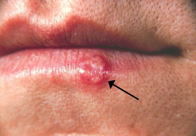 Photograph of a cluster of small fluid-filled blisters on the lower lip, typical of a cold sore.