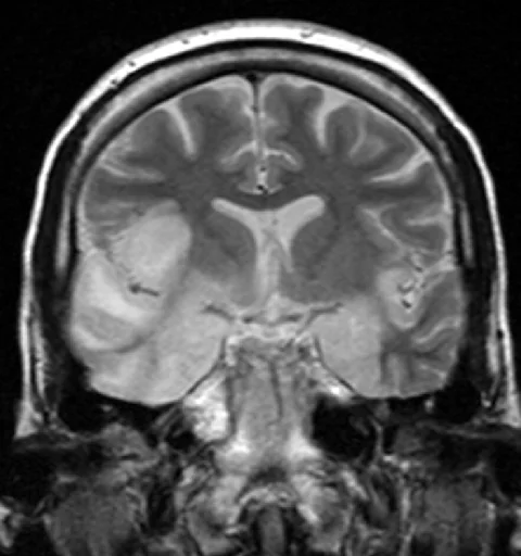Coronal T2-weighted MRI brain scan showing abnormal high signal in both temporal lobes.