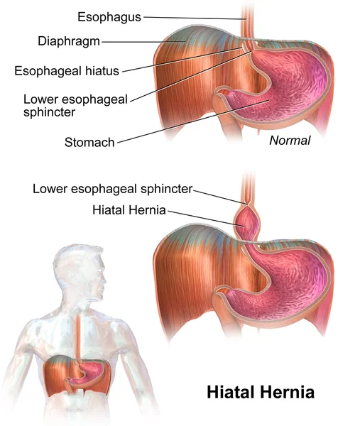 Two anatomical illustrations. The upper shows normal anatomy with the oesophagus passing through the oesophageal hiatus of the diaphragm and the lower oesophageal sphincter sitting below it. The lower shows a hiatus hernia with the upper stomach and the sphincter displaced above the level of the diaphragm.