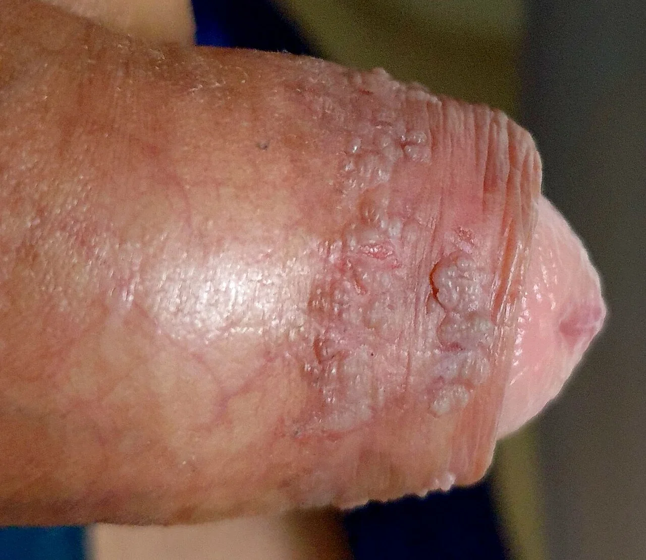 Photograph of multiple warty papules on the foreskin of the penis caused by genital HPV infection.