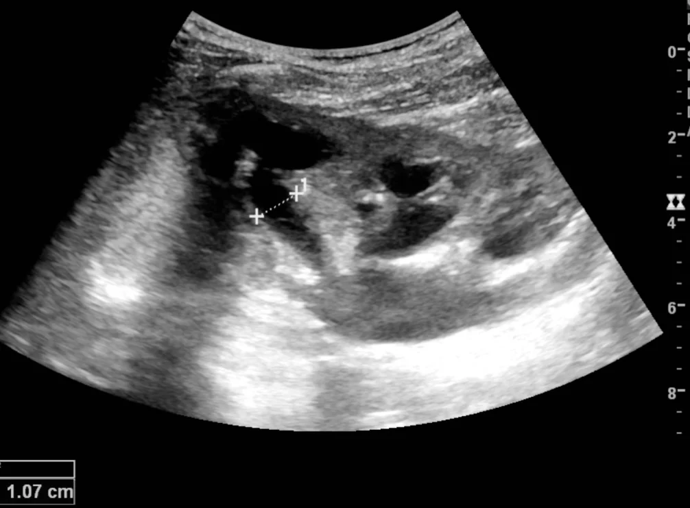 Renal ultrasound image showing the kidney with a markedly dilated anechoic (black) renal pelvis and calyces, and a thinned rim of surrounding renal cortex.