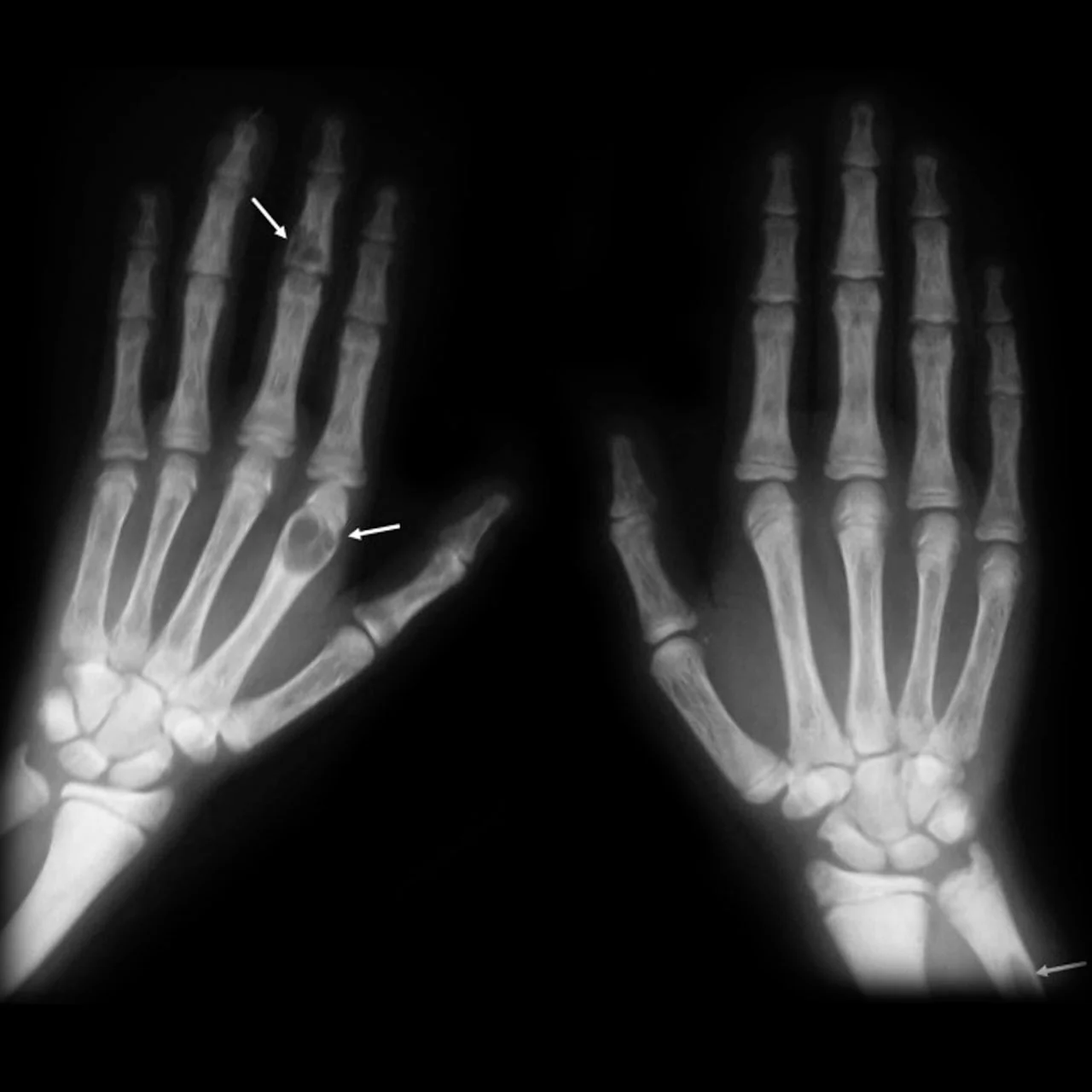 Radiograph of both hands showing lucent, expansile lytic lesions within several phalanges, consistent with brown tumours, alongside subperiosteal bone resorption along the radial margins of the middle phalanges.