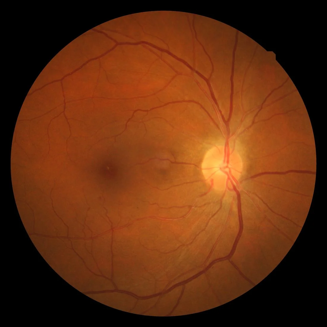 Fundus photograph in hypertensive retinopathy, showing narrowed retinal arterioles, flame-shaped haemorrhages and cotton wool spots around the optic disc and along the vascular arcades.