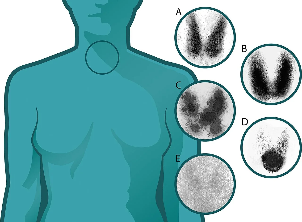 Five circular thyroid scintigraphy images labelled A to E alongside an outline of a torso: A shows even uptake in both lobes, B shows intense uniform uptake throughout an enlarged gland, C shows patchy uptake with several dark and pale areas, D shows a single intensely dark nodule with the rest of the gland suppressed, and E shows almost no uptake at all.
