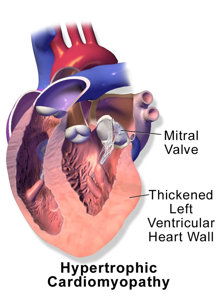 Cutaway illustration comparing a normal heart with one affected by hypertrophic cardiomyopathy, in which the interventricular septum is markedly thickened and the left ventricular cavity correspondingly small.