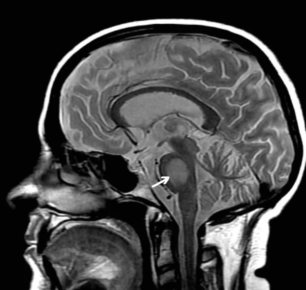 Sagittal T2-weighted MRI of the brain showing an abnormal high signal area within the central pons, characteristic of central pontine myelinolysis.