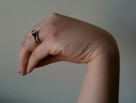 Photograph of a hand held in the classic tetanic posture of carpal spasm, with the wrist flexed, fingers extended and drawn together, and the thumb flexed across the palm.