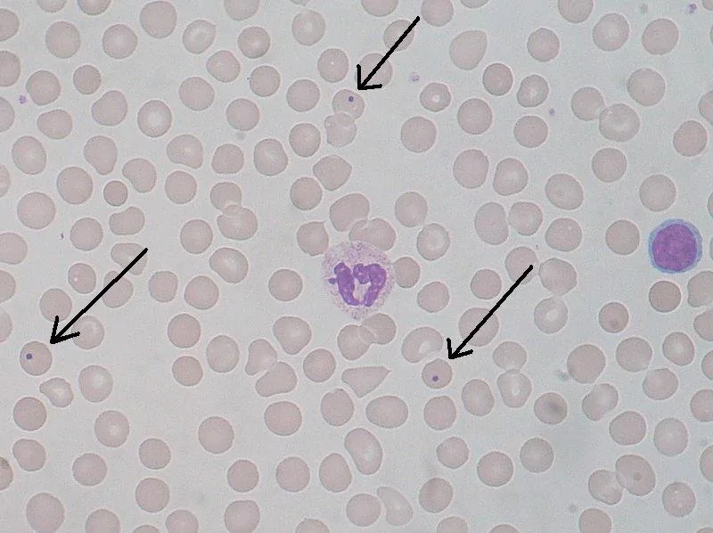 Peripheral blood film with arrows indicating Howell-Jolly bodies, small dark round nuclear remnants within red blood cells.