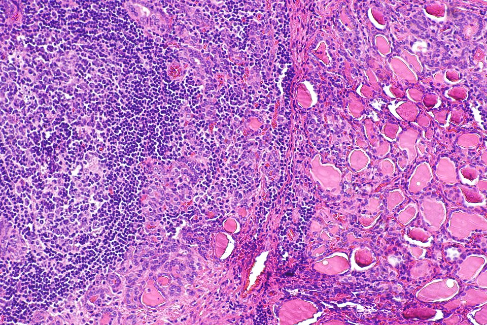 Haematoxylin and eosin micrograph of thyroid tissue showing, on the left, a dense blue-purple lymphoid infiltrate with a germinal centre, and on the right, residual pink colloid-filled thyroid follicles being progressively replaced.