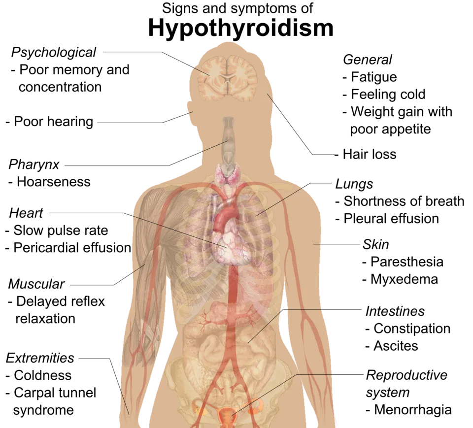 Labelled anatomical illustration of a female torso listing the signs and symptoms of hypothyroidism by system - psychological, pharyngeal, cardiac, muscular, extremities, general, respiratory, skin, intestinal and reproductive.