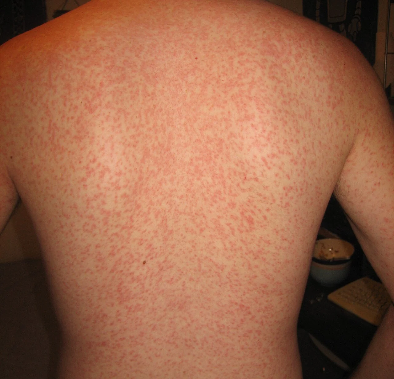 Photograph of widespread erythematous maculopapular rash on the trunk and arms, caused by ampicillin given during infectious mononucleosis.