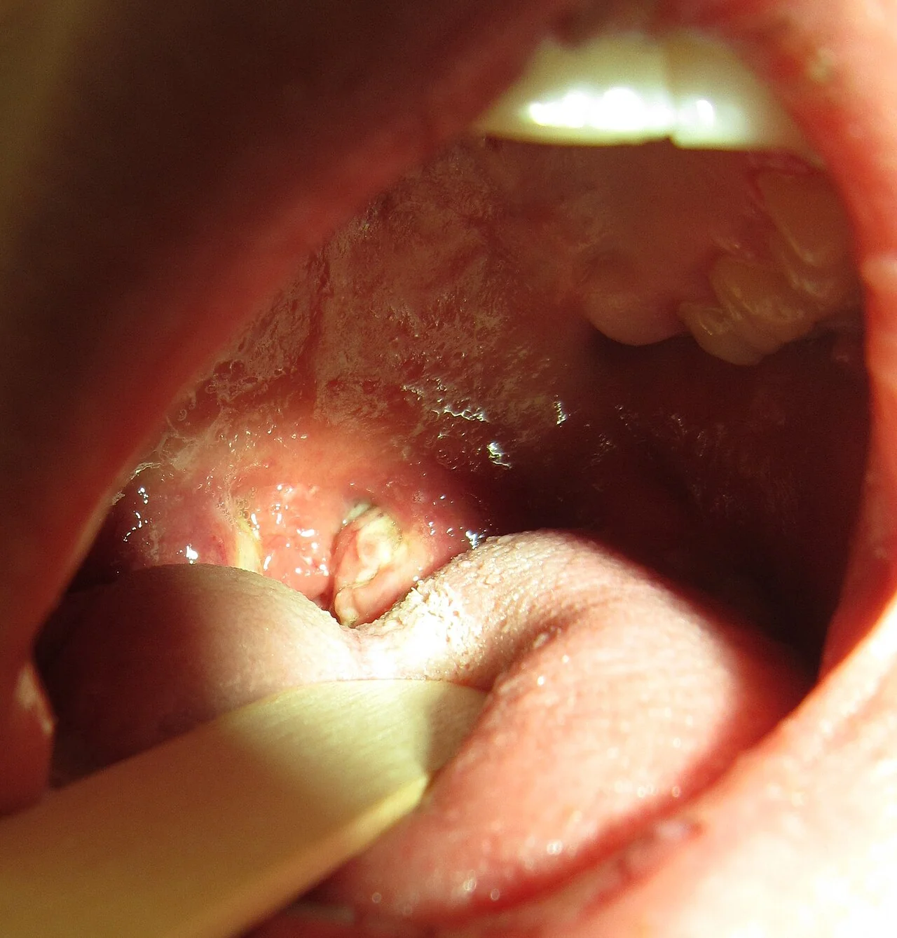 Photograph of the oropharynx showing enlarged, erythematous tonsils covered with white-grey exudate, typical of infectious mononucleosis.