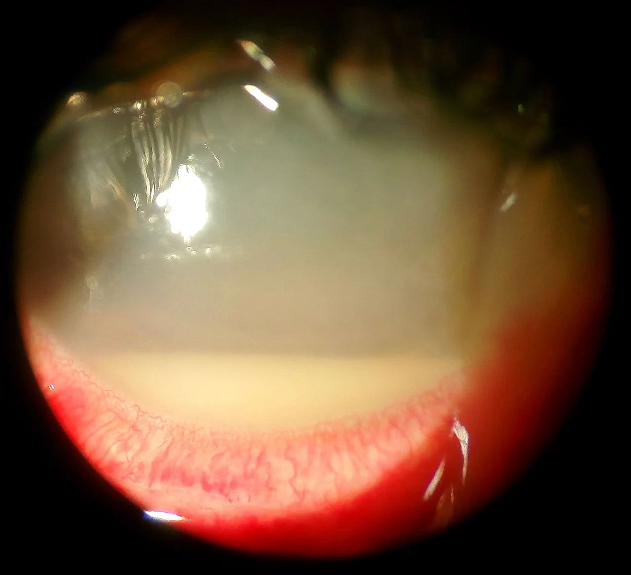 Slit lamp photograph of an eye showing a hypopyon, a white horizontal layer of inflammatory cells settled in the lower part of the anterior chamber behind the cornea, with a hazy cornea above it.