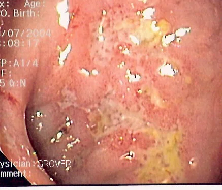 Colonoscopic image showing a long, winding serpiginous ulcer on the colonic mucosa in Crohn's disease.