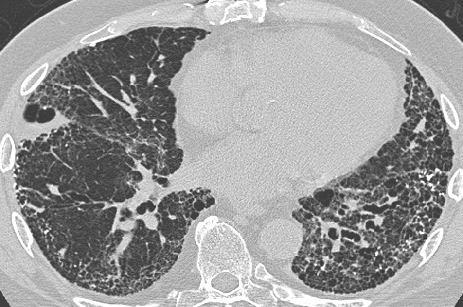Axial high-resolution CT of the lower chest on lung windows showing clustered subpleural cystic airspaces of similar size stacked in layers around the periphery of both lungs, with coarse reticulation, architectural distortion and dilated airways running into the fibrosis.