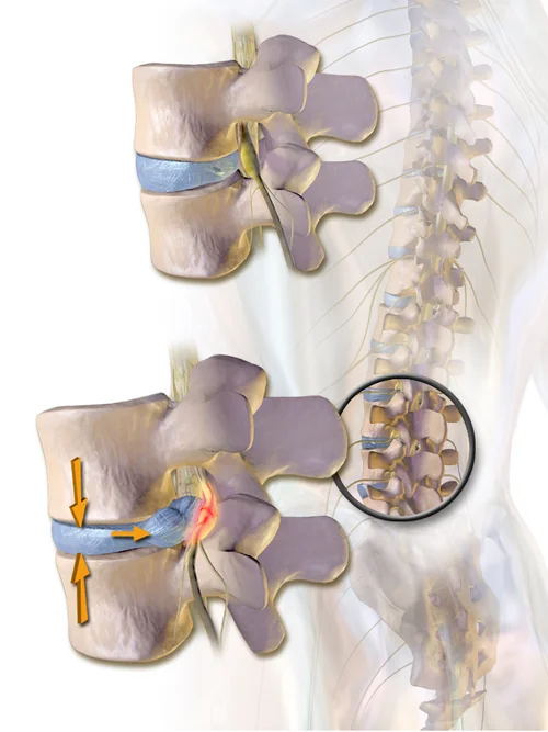 Illustration of two lumbar vertebrae in cross-section, showing a normal intervertebral disc alongside a herniated one in which nucleus pulposus material has extruded posteriorly through the annulus and is pressing on the adjacent spinal nerve root.