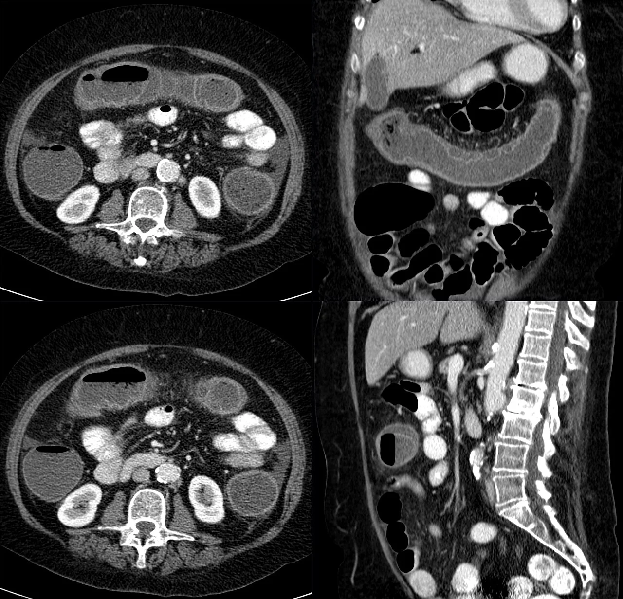 Axial CT image of the abdomen showing thickened, oedematous colonic wall with surrounding fat stranding in ischaemic colitis.