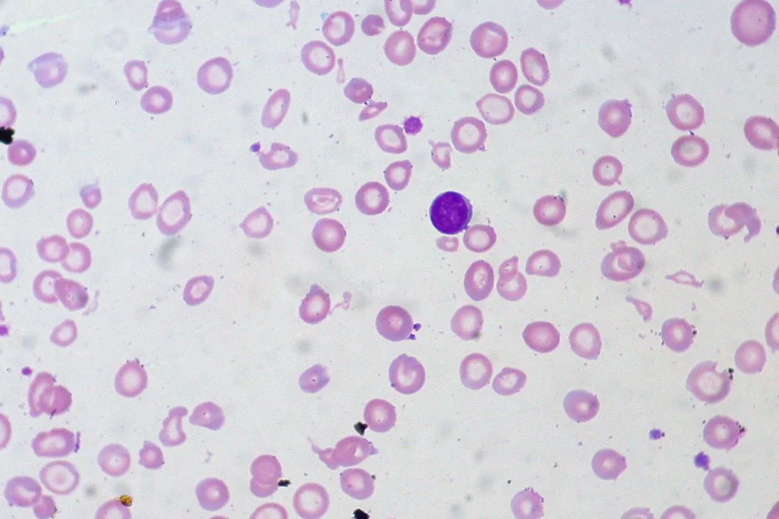 Peripheral blood film showing small, pale red blood cells with an area of central pallor larger than normal, consistent with microcytic hypochromic anaemia.