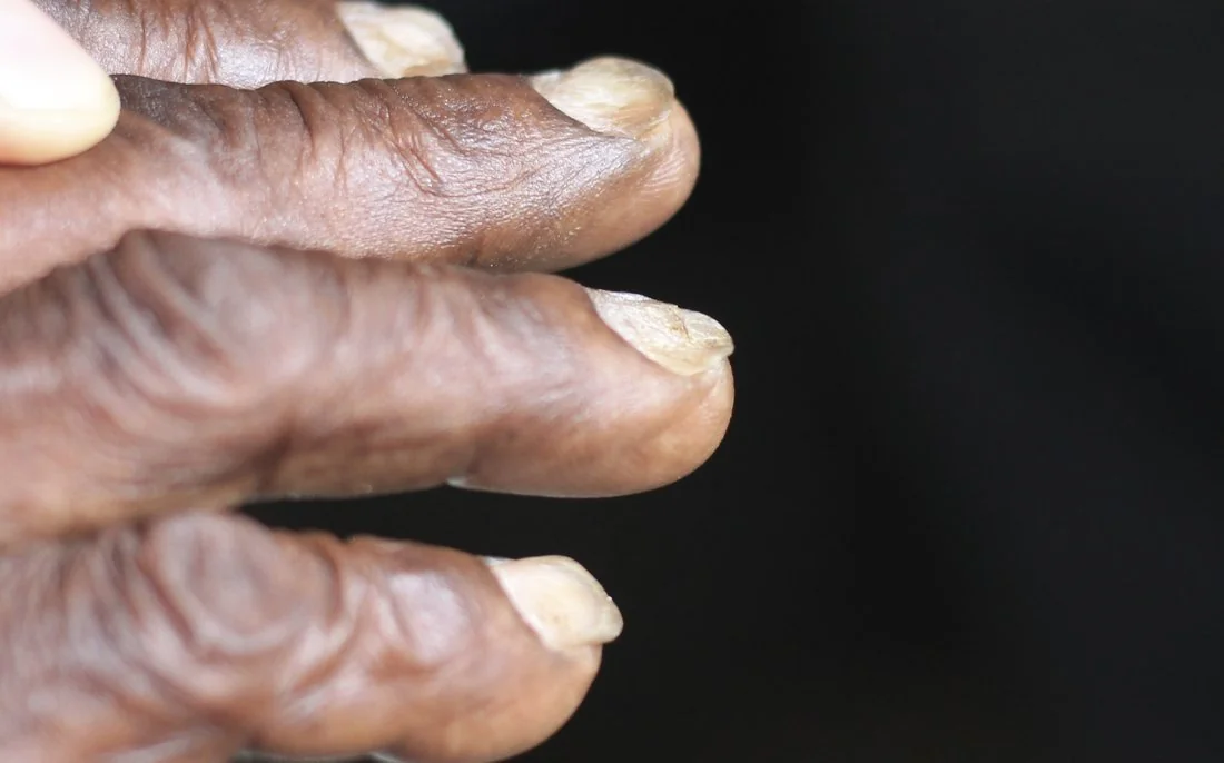 Photograph of a hand showing koilonychia, with spoon-shaped concave fingernails.