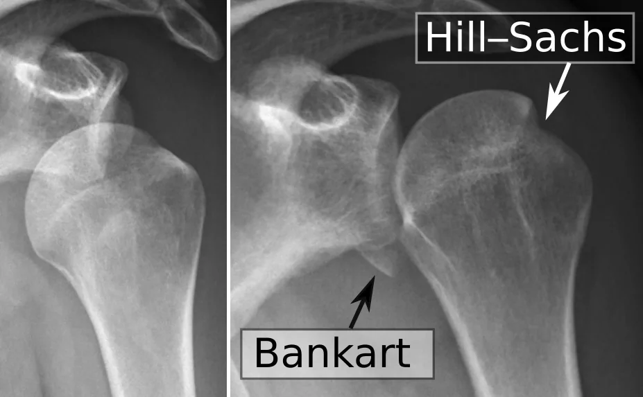 Paired anteroposterior shoulder radiographs of a 25-year-old man. The left image shows the humeral head displaced anteriorly and inferiorly out of the glenoid. The right image, taken after reduction, shows the humeral head relocated, with labels marking a bony Bankart lesion of the anteroinferior glenoid and a Hill-Sachs impaction defect of the posterolateral humeral head.